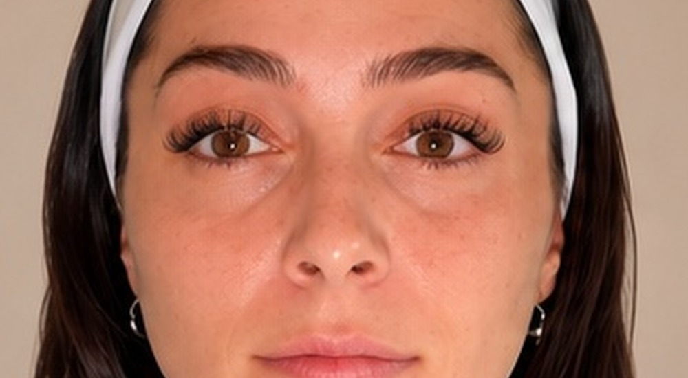 Before Botox forehead lines treatment at Silk Clinics Dubai — patient at rest showing horizontal forehead wrinkles.