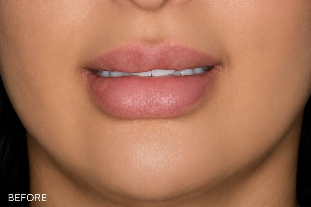 Lip and chin filler before and after results at Silk Clinics Dubai — patient before combination filler treatment showing thin lips and minimal chin projection.