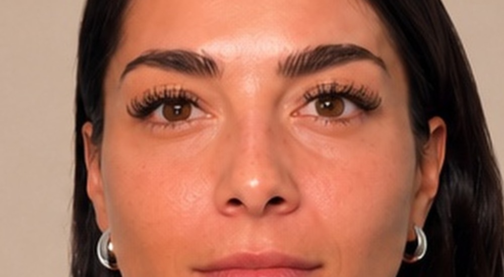 After Botox forehead lines treatment at Silk Clinics Dubai — smoother forehead with natural brow position preserved.