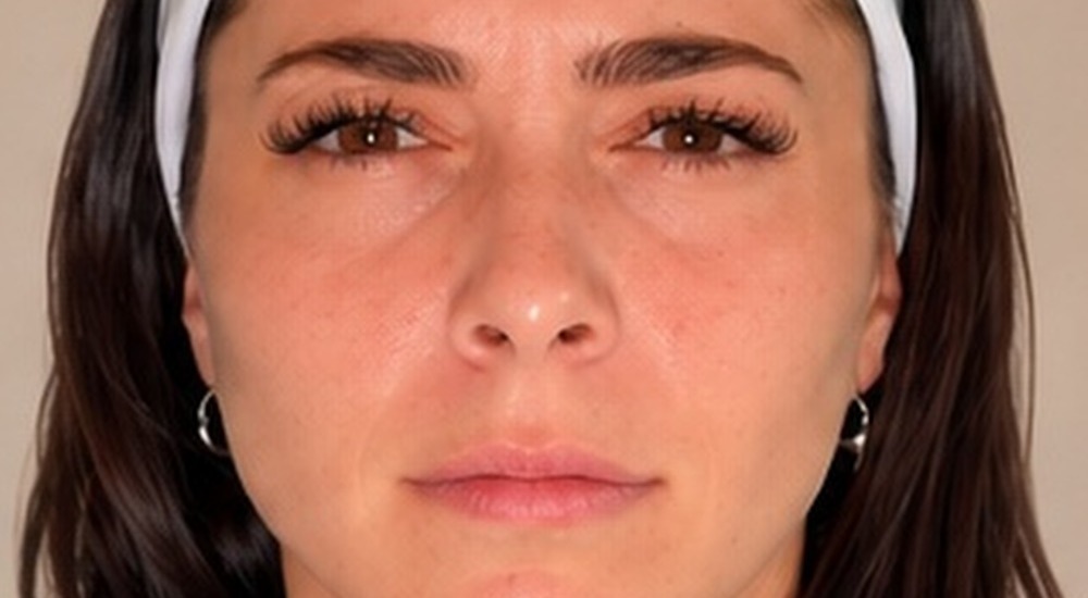 Before Botox frown lines treatment at Silk Clinics Dubai — patient frowning showing deep vertical glabellar lines between the brows.